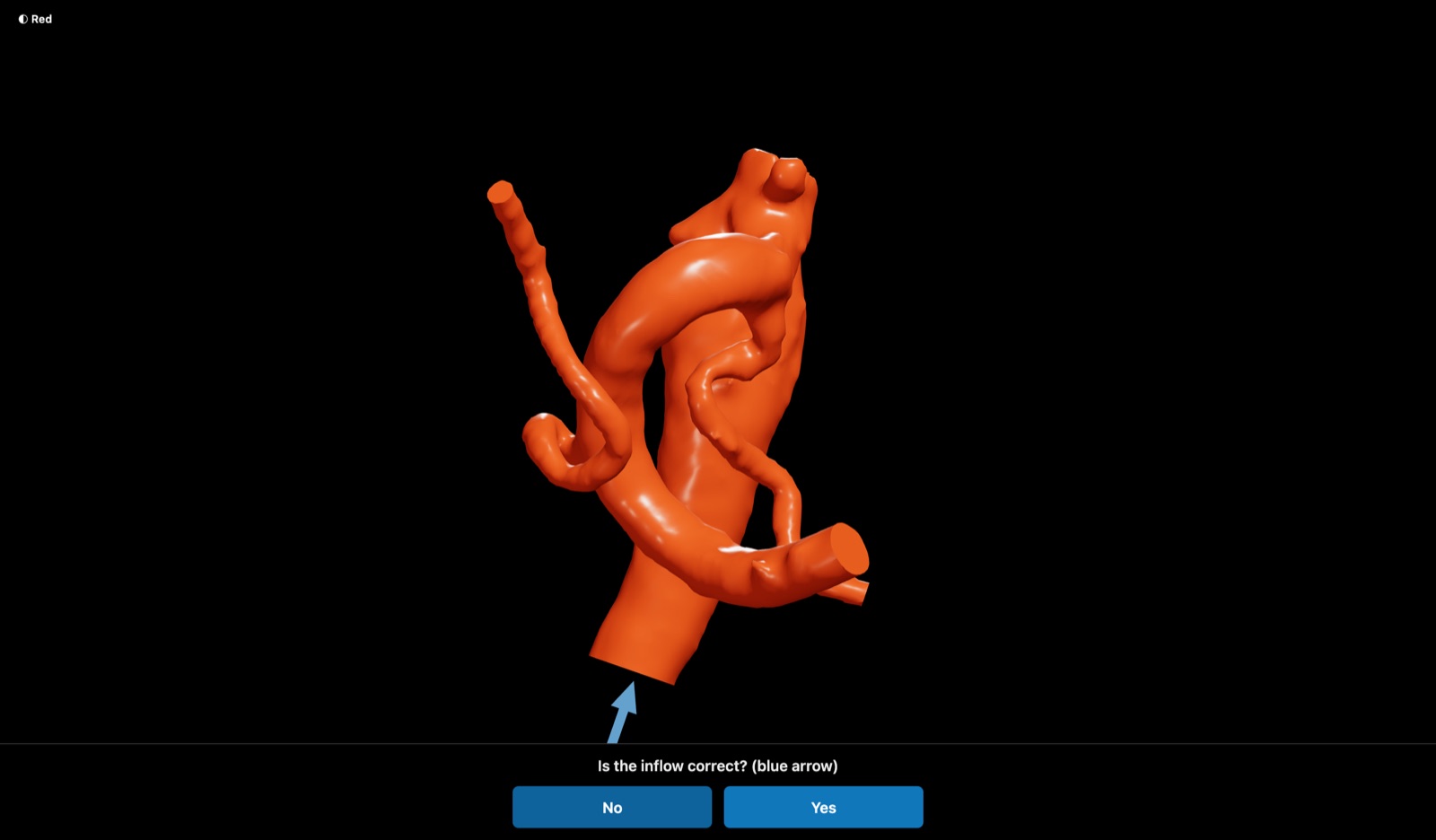Tortuous carotid anatomy reconstructed from DICOM