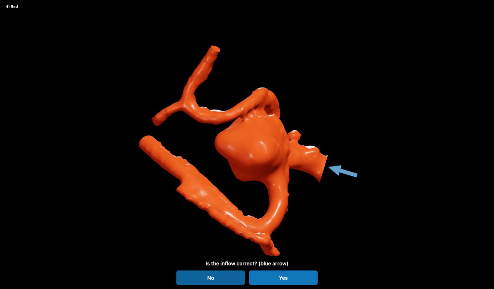 Side-wall aneurysm reconstructed from DICOM