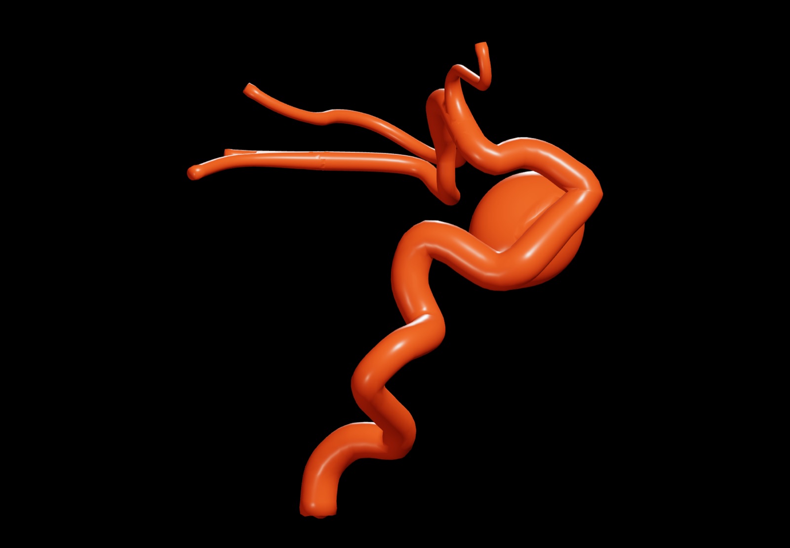 A full carotid with a cavernous-segment aneurysm in the app's 3D viewer