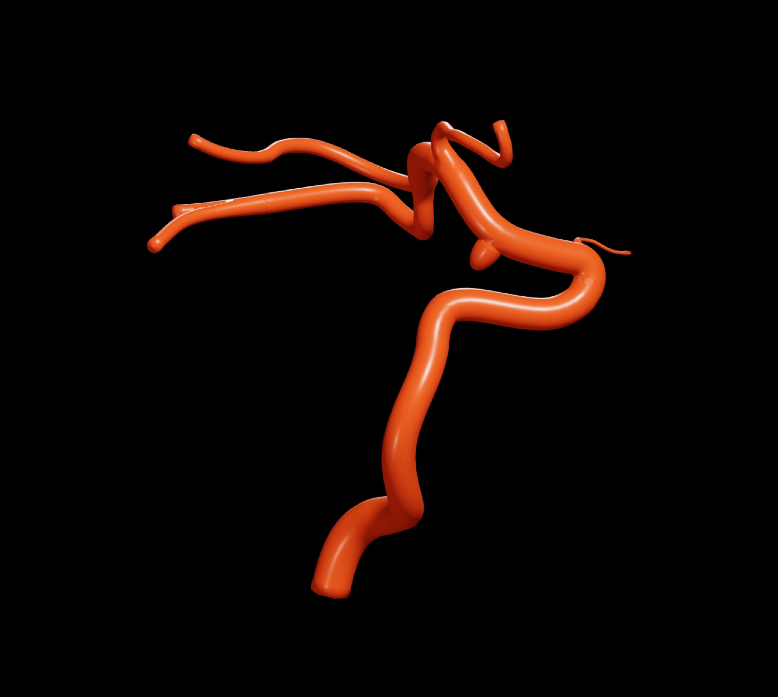 The Communicating template: a full carotid with a communicating-segment aneurysm