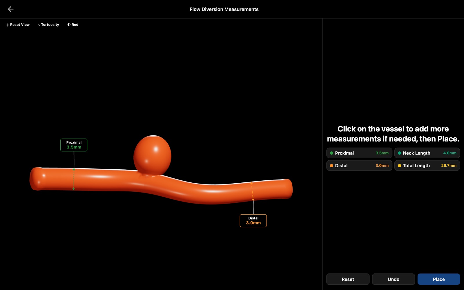 Click the vessel either side of the aneurysm to set proximal and distal diameters.