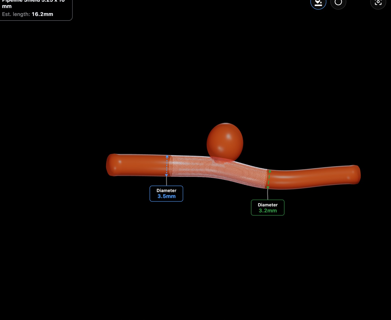 Flow diverter placed along the parent vessel.