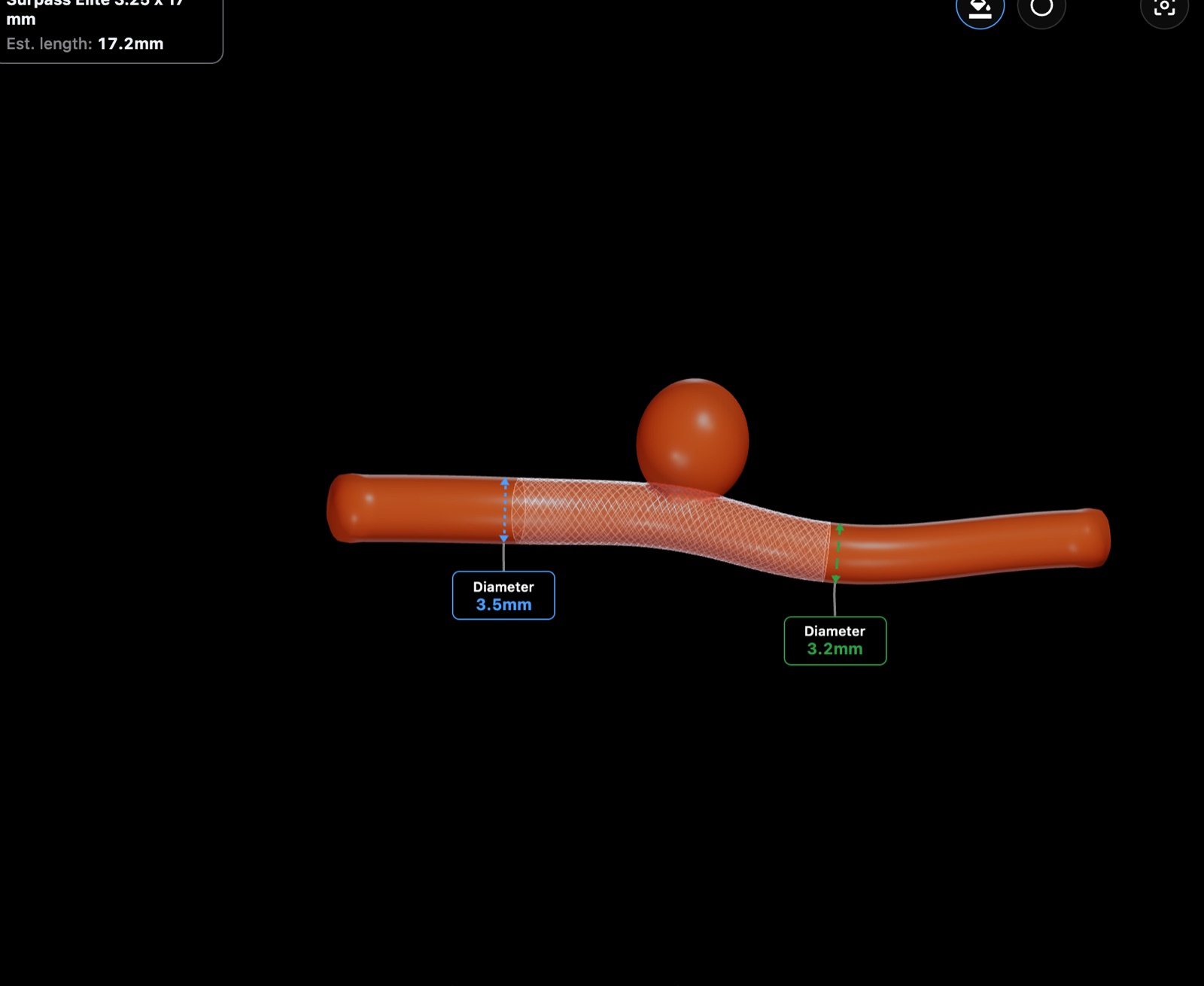Flow diverter placed along the parent vessel.